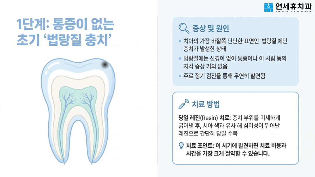 통증이 없는 초기 1단계 법랑질 충치의 증상 및 당일 레진 치료 방법 안내
