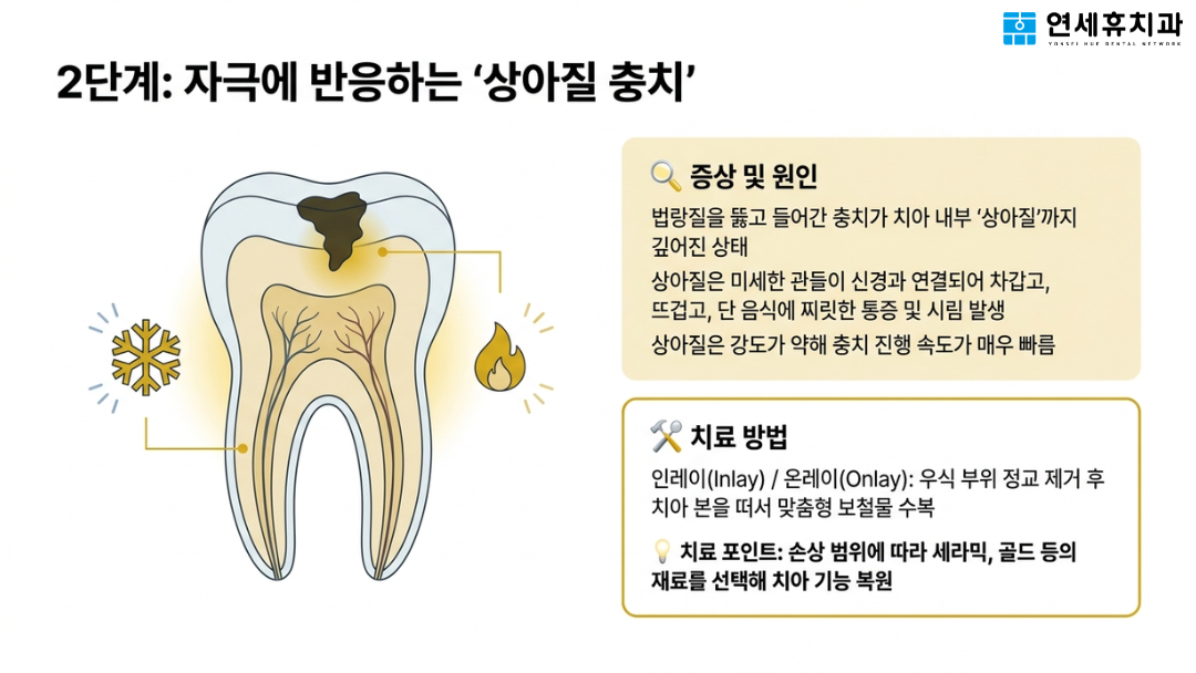 시린 치아와 찌릿한 통증을 유발하는 2단계 상아질 충치 원인 및 인레이, 온레이 보철물 치료 방법