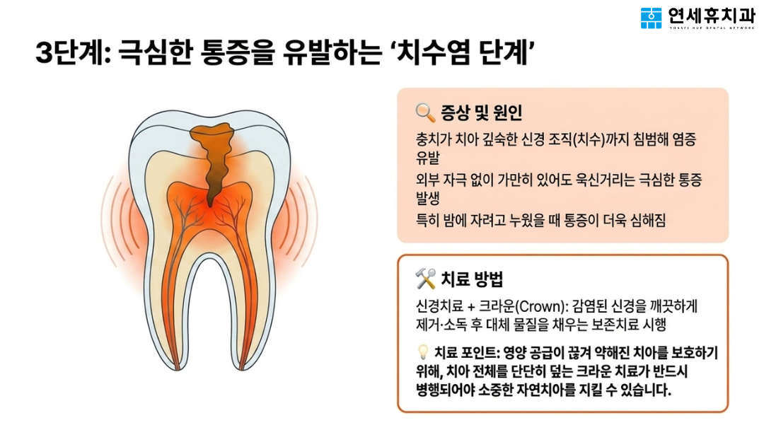 가만히 있어도 극심한 치통을 유발하는 3단계 치수염 증상과 자연치아 보존을 위한 신경치료 및 크라운 치료 안내