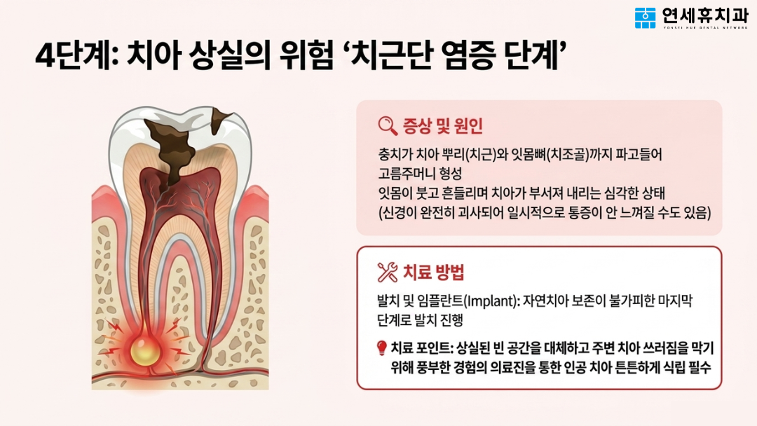 치아 상실 위험이 있는 4단계 치근단 염증 원인과 자연치아 보존이 불가피할 때 진행하는 발치 및 임플란트 치료 방법