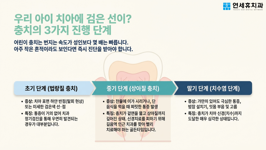 진행 속도가 빠른 어린이 소아충치의 3가지 진행 단계인 초기 법랑질 충치, 중기 상아질 충치, 말기 치수염 단계의 원인 및 증상